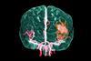 MRA image stroke victim brain